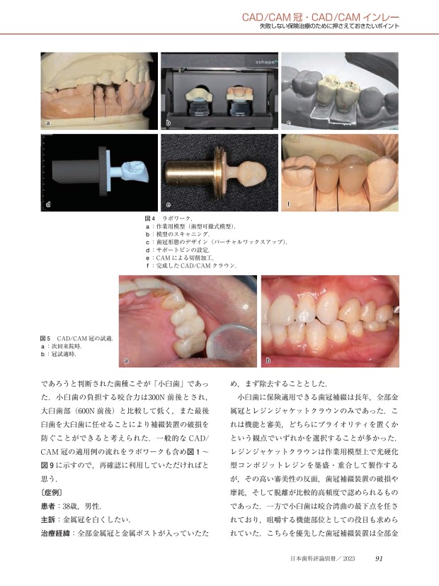 Amazon.co.jp: 保険の審美修復を極める: CR&CAD/CAM冠・インレー