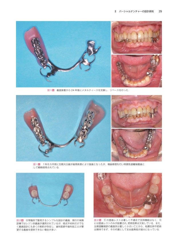 歯牙模型 補綴 歯科 下顎遊離端欠損 歯牙模型 歯科 下顎遊離端欠損 遊離