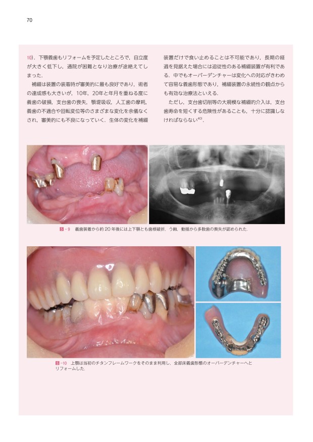 アドバンスド デンチャー テクニック