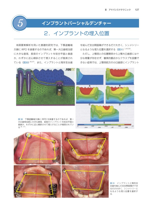 アドバンスド デンチャー テクニック