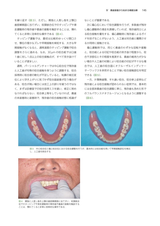 アドバンスド デンチャー テクニック