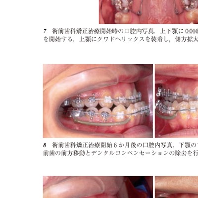 日本歯科評論＿顎変形症の術前歯科矯正治療のすすめ方