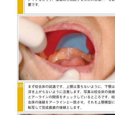 きちんと確実にできる全部床義歯の咬合採得