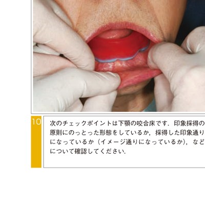 きちんと確実にできる全部床義歯の咬合採得