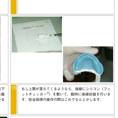 きちんと確実にできる全部床義歯の咬合採得