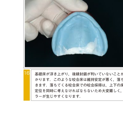 きちんと確実にできる全部床義歯の咬合採得