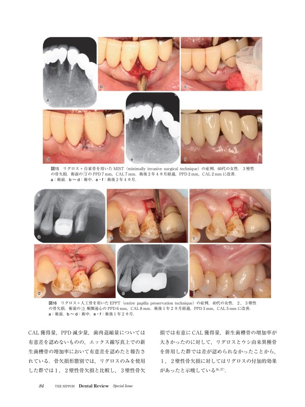歯周外科のベーシック＆アドバンス